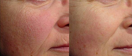 before and after laser facials