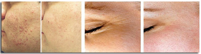 microderm before and after