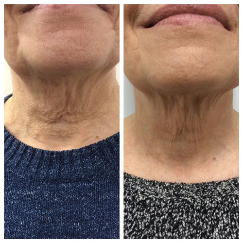 plasma pen before and after treatment